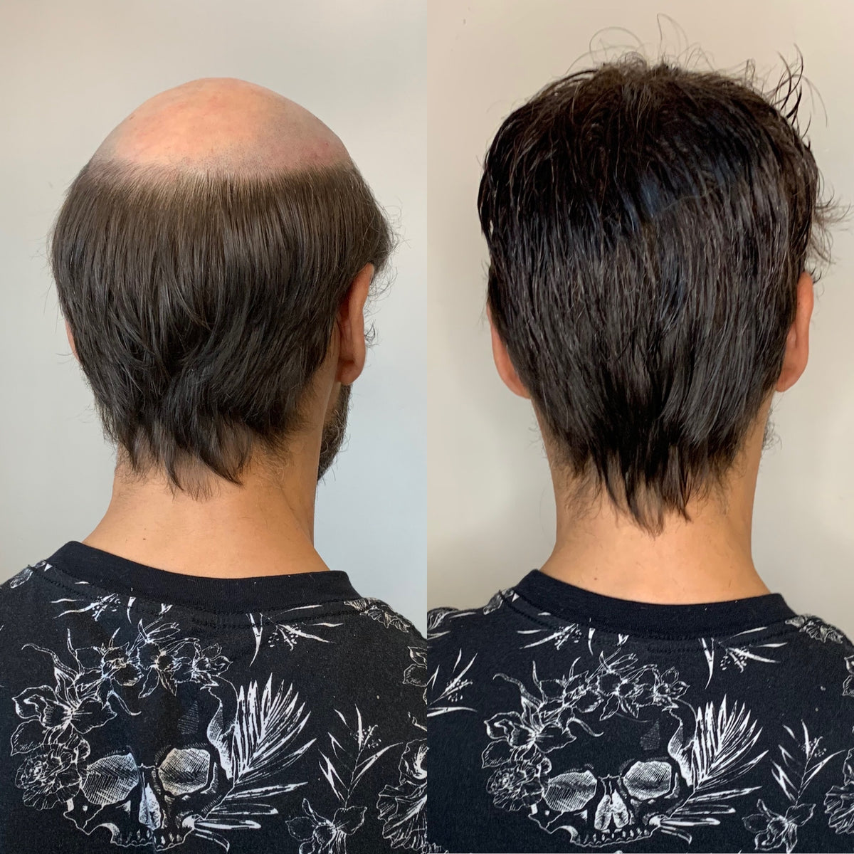 Hair Restoration Systems